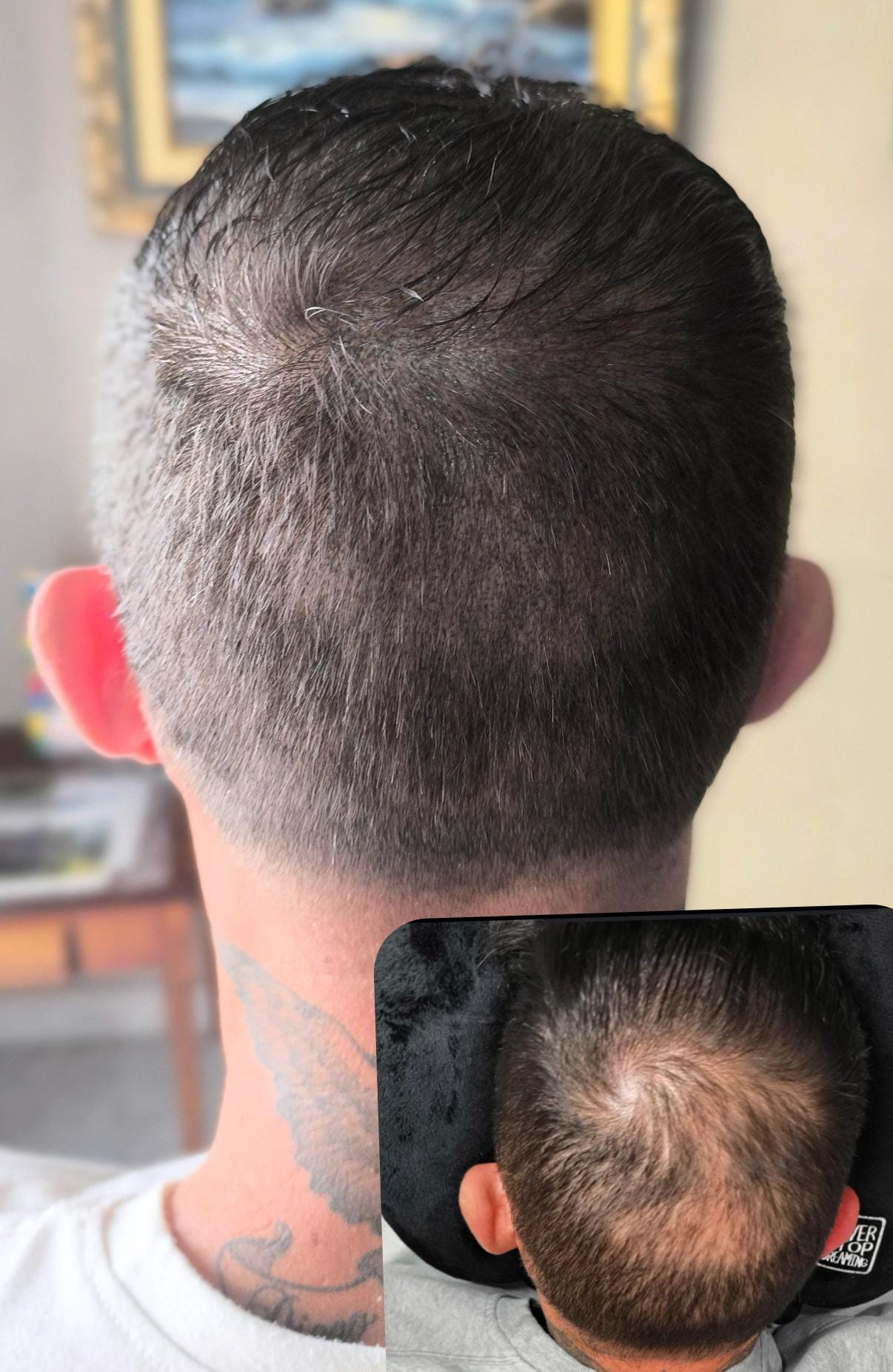 Resultado Micropigmentación Capilar