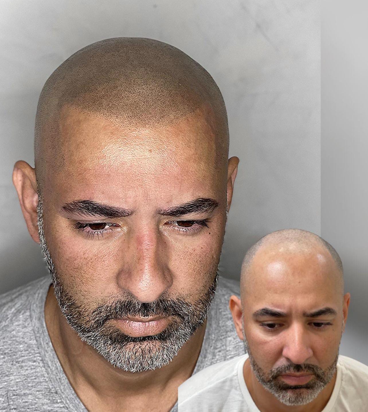 Resultado Micropigmentación Capilar