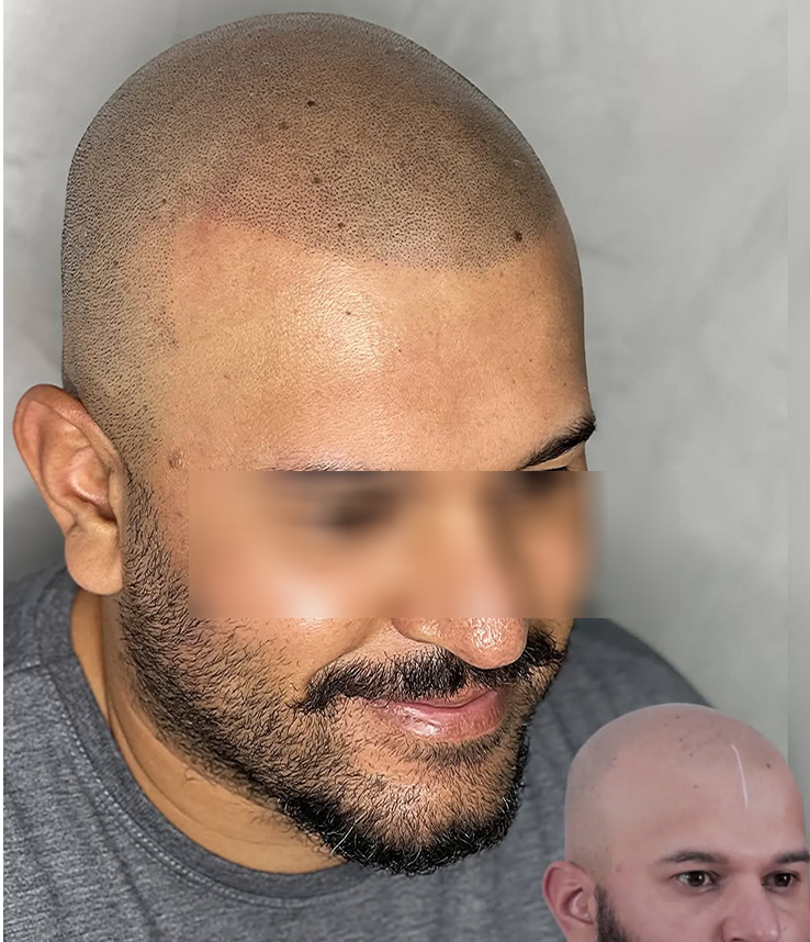 Resultado Micropigmentación Capilar