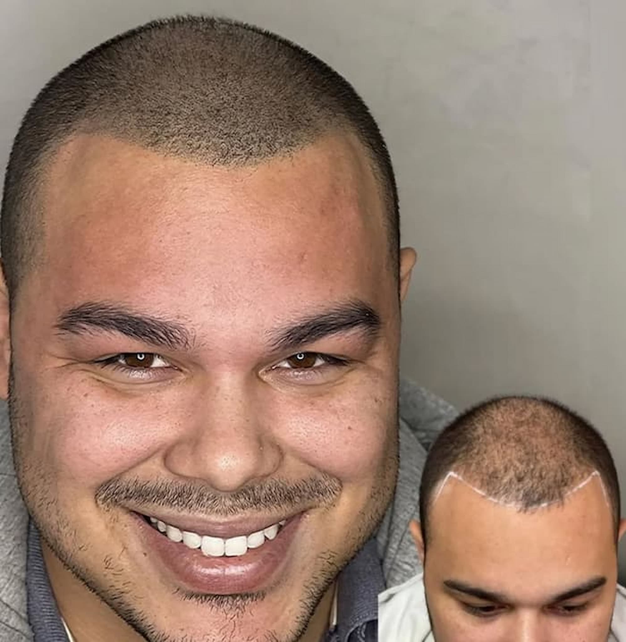 Resultado Micropigmentación Capilar