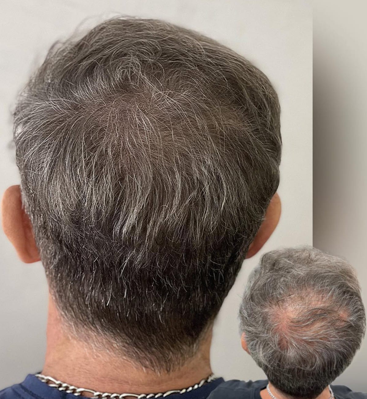 Resultado Micropigmentación Capilar