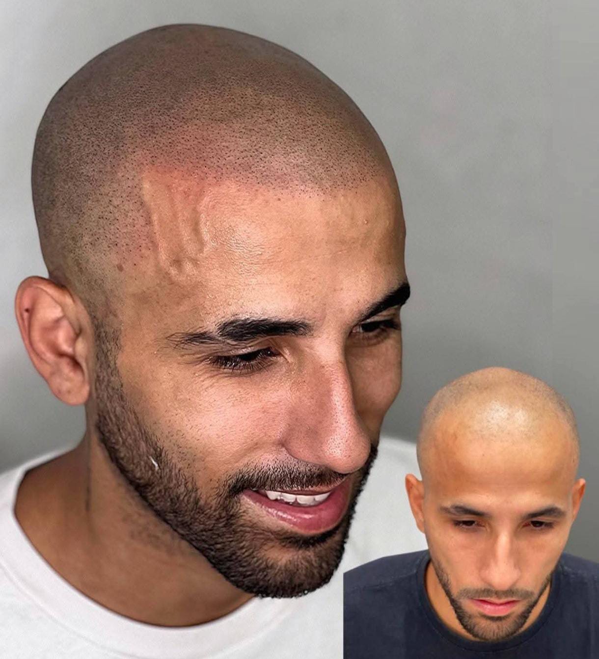 Resultado Micropigmentación Capilar