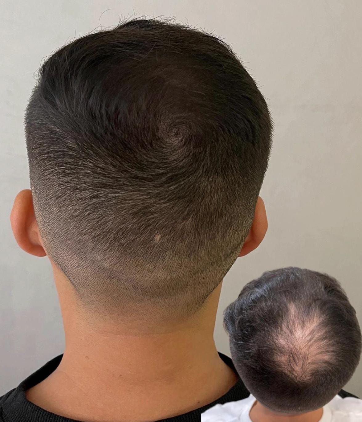 Resultado Micropigmentación Capilar