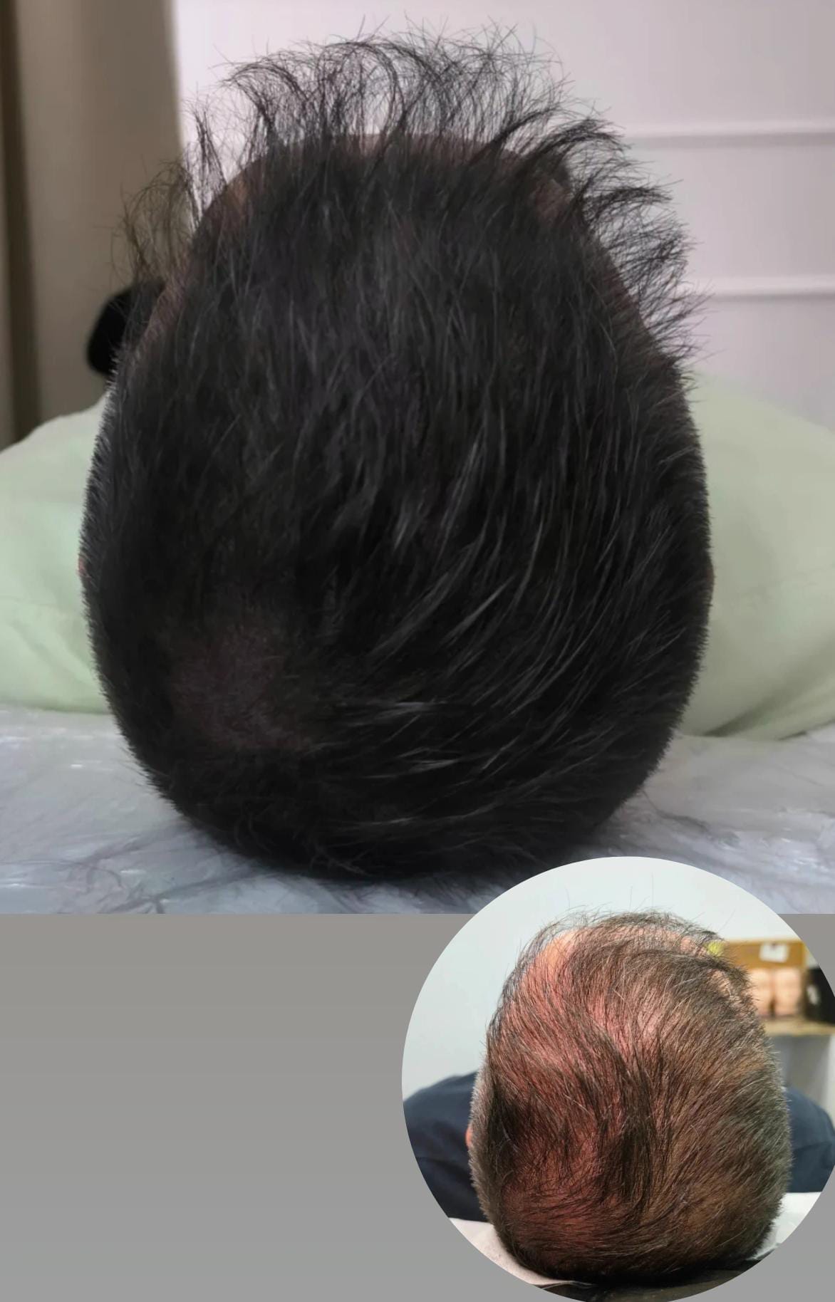 Resultado Micropigmentación Capilar