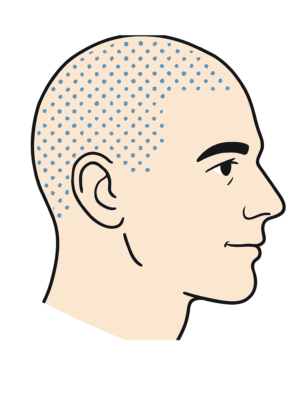 Aumento de densidad - Micropigmentación Capilar